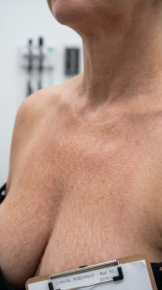 Crepey, loose décolletage skin